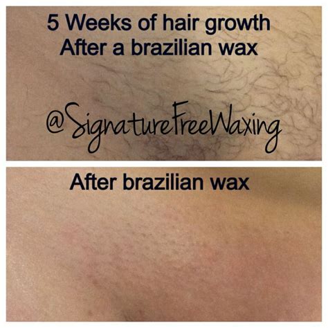 brazilian hair removal styles
